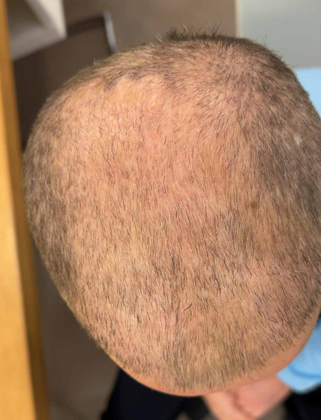 vorher-nachher-kollerhair_07-2025-vorher